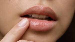 Granulomas por rellenos permanentes: por qué siguen apareciendo años después de una moda pasada