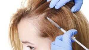 PRP capilar: qué hay detrás del «plasma rico en plaquetas» para la caída del cabello
