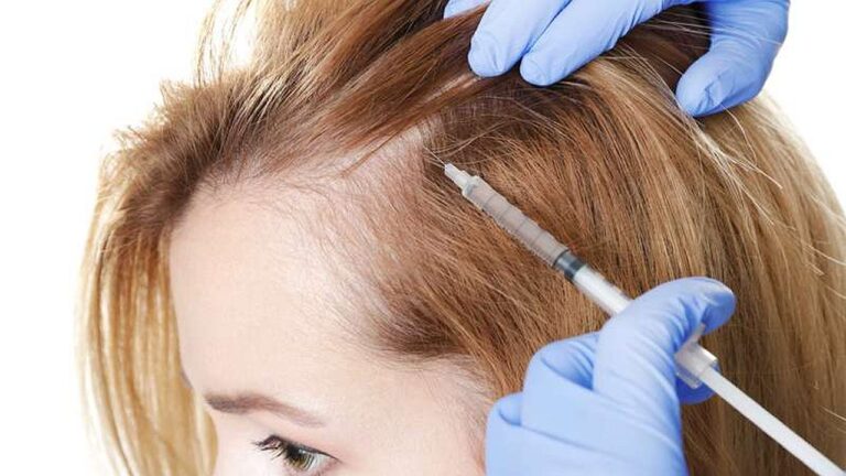 PRP capilar: qué hay detrás del «plasma rico en plaquetas» para la caída del cabello